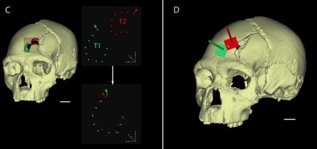  Researchers used a 3D model to analyze the skull's two fractures in detail. Photo: Sala et al., PLOS ONE Read more: http://www.smithsonianmag.com/science-nature/investigating-case-earliest-known-murder-victim-180955409/#hc2peOxEZoyFx4yj.99 Give the gift of Smithsonian magazine for only $12! http://bit.ly/1cGUiGv Follow us: @SmithsonianMag on Twitter